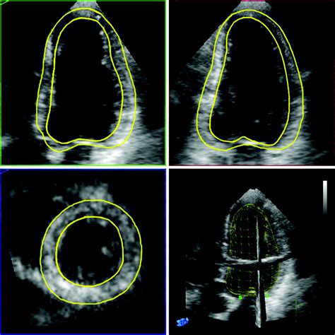 lv mass とは|left ventricular mass treatment.